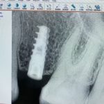 implants in dubai - all smiles dental spa