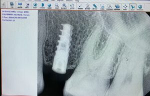 implants in dubai - all smiles dental spa