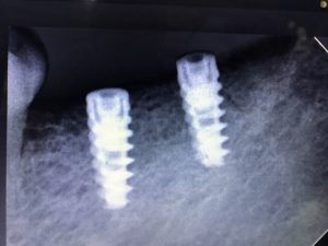 dental implants by all smiles dental spa