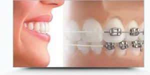 tips for beautiful smile after braces - Dubai Dentist