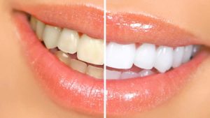 tips to whiten teeth