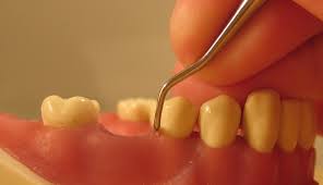 periodontitis disease affected teeth