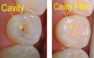 Filling the cavity