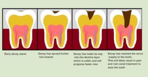 tooth decay progression