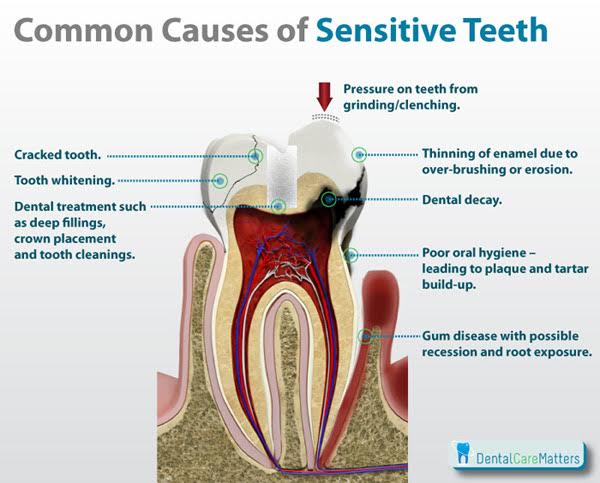 Sensitive Teeth Treatment Causes All Smiles Dent Spa
