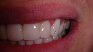 tooth jewelry in Dubai - all smiles dental spa
