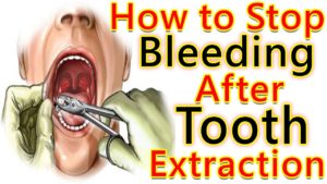 how to stop bleeding- Treatment for bleeding gums
