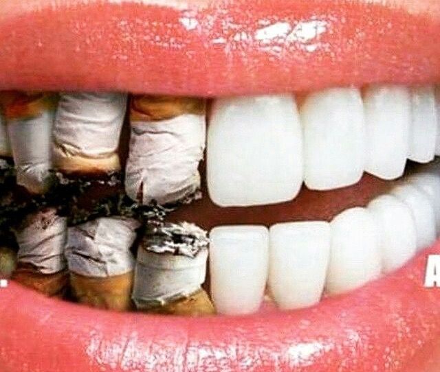 Smoking Teeth Malaysia Oral Health All Smiles Dent Spa