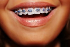 tooth extraction and braces placements