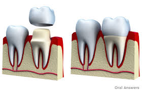 crown tooth image