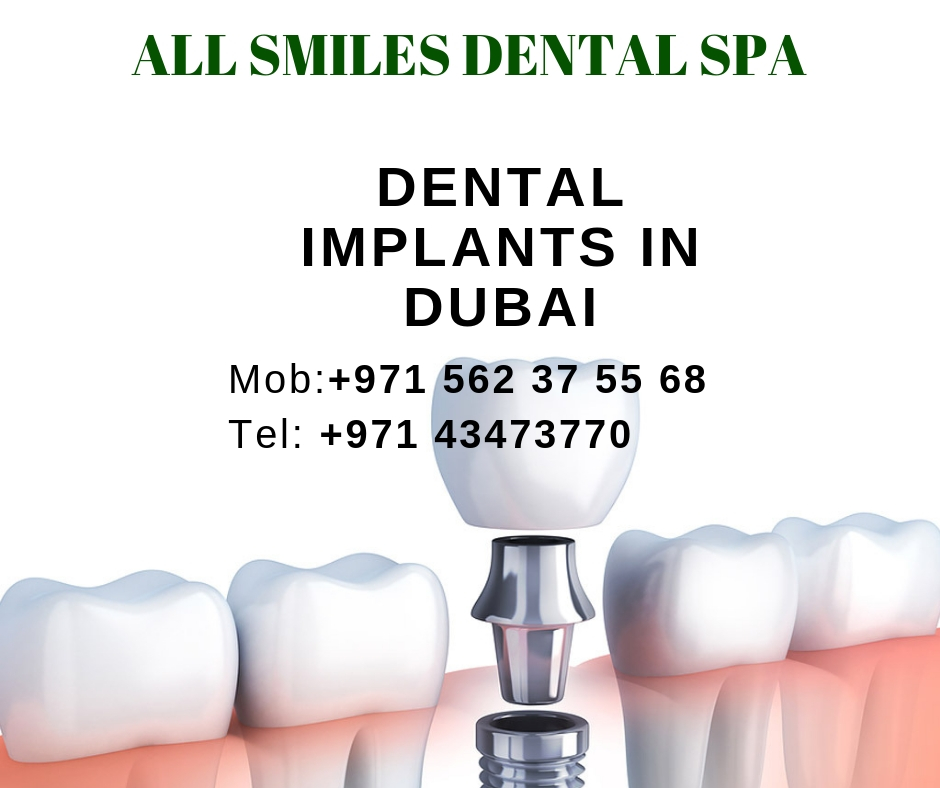 best dental implants in Dubai