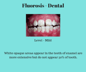mild dental fluorosis
