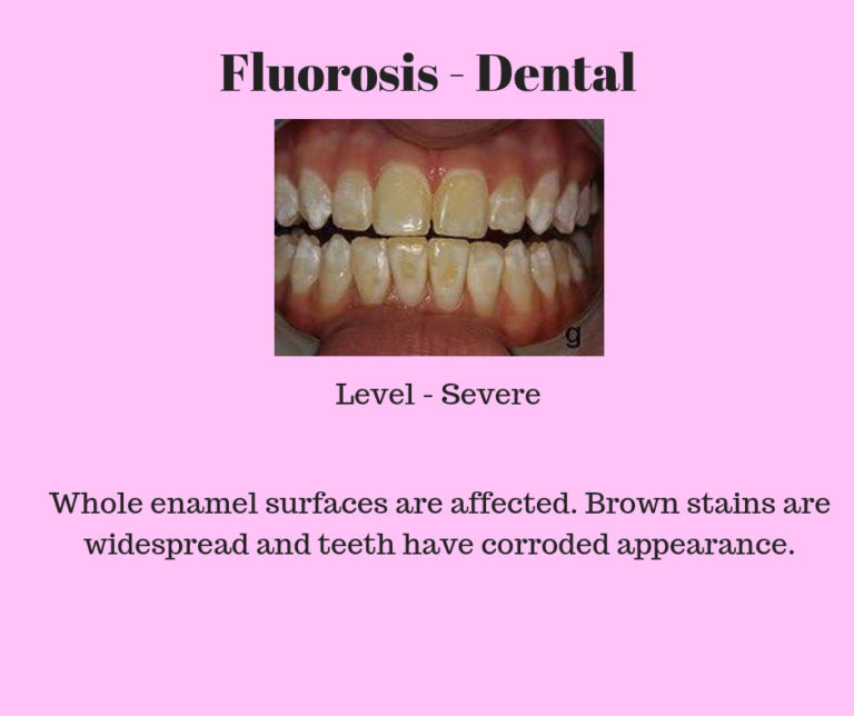 Severe-dental-fluorosis - All Smiles Dent Spa