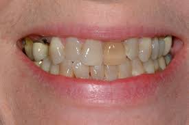 bulimias effect on teeth