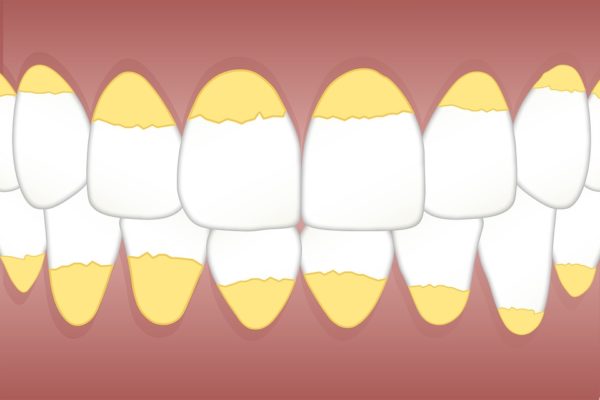 teeth calculus growth rate