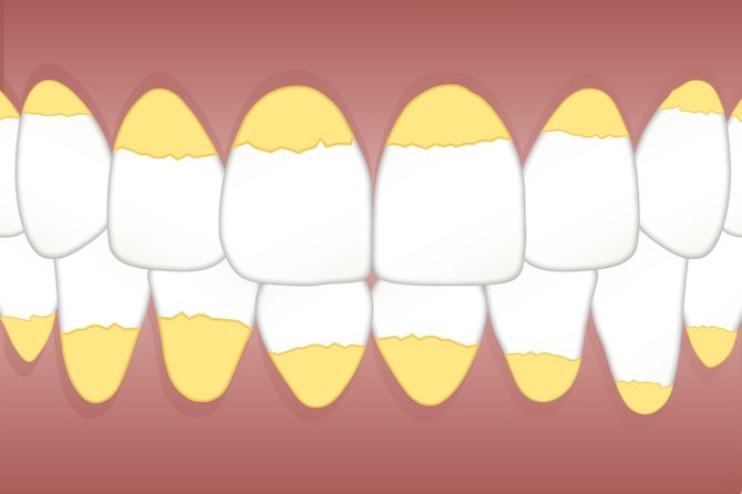 dental calculus classification