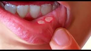 oral ulcer