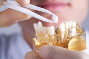 Benefit of dental implants