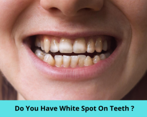 How To Remove White Spots On Teeth