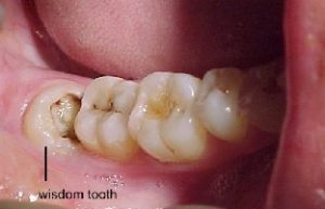 tooth-decay