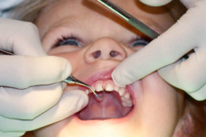 causes_of_Dental_Cavities