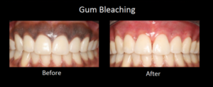 Gum-Bleaching-before-and-after