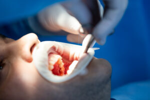 Placing Crowns Over Root Canal teeth