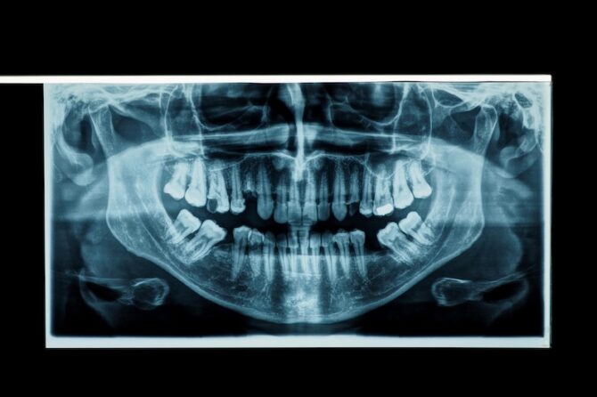 The Importance of Dental X-Rays in Your Dental Checkup