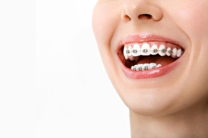 How Do I Care For My Teeth While Wearing Braces?