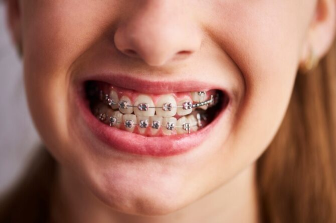 Can Braces Make Your Teeth Loosen or Fall Out?