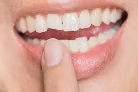 Fractured Tooth or Teeth