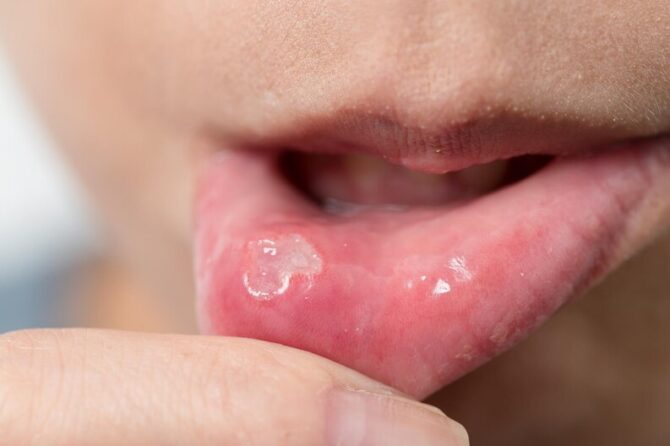 Healing Mouth Woes: The Ultimate Canker Sore Solution Guide
