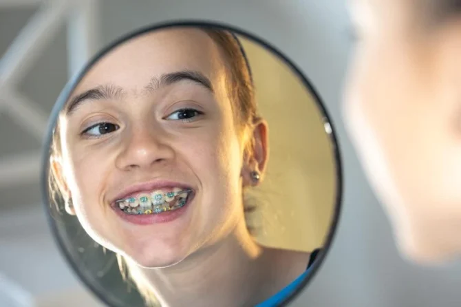 Exploring Braces Options in Depth for Perfecting Your Child’s Smile