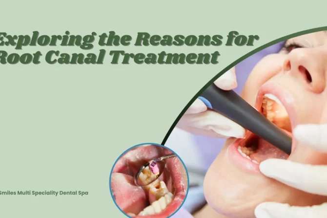 Exploring the Reasons for Root Canal Treatment