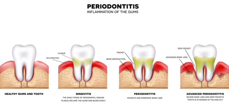 Importance of Periodontal Health