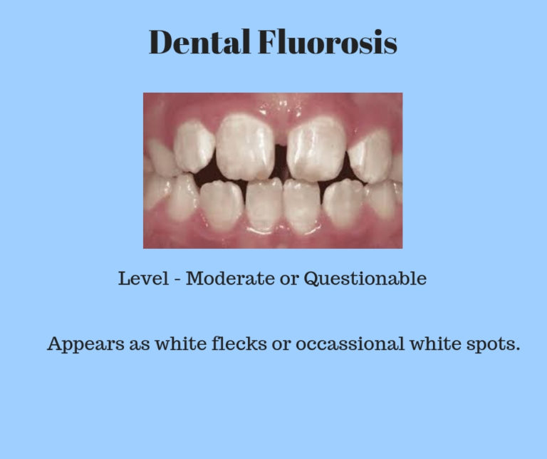 Dental Fluorosis - Symptoms, Causes, Treatments